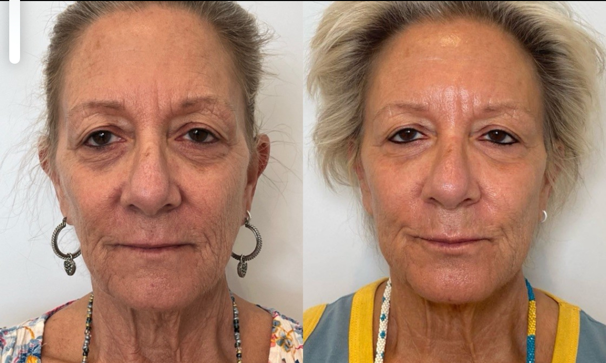 https://www.theperfectdose.com/wp-content/uploads/2024/10/Coolpeel.jpg