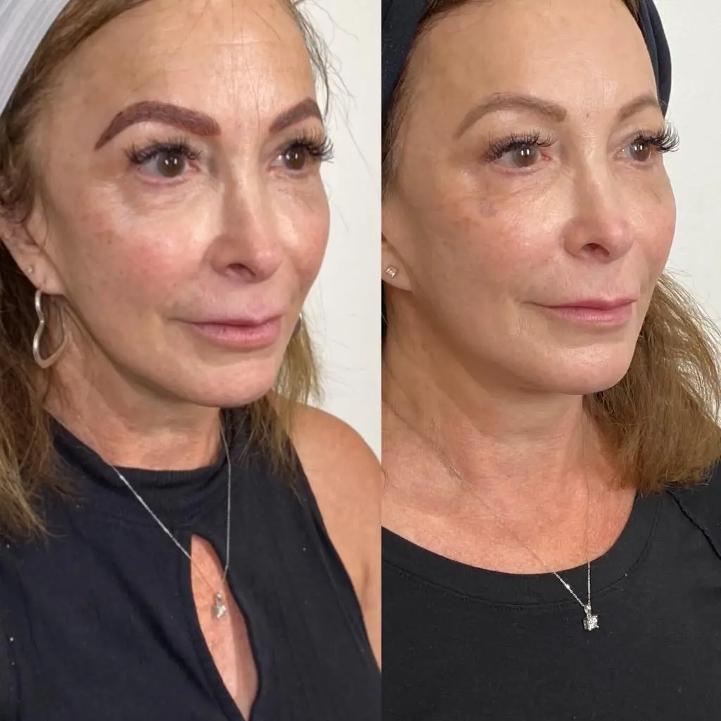 JLO Glow facial before and after results at Perfect Dose Med Spa