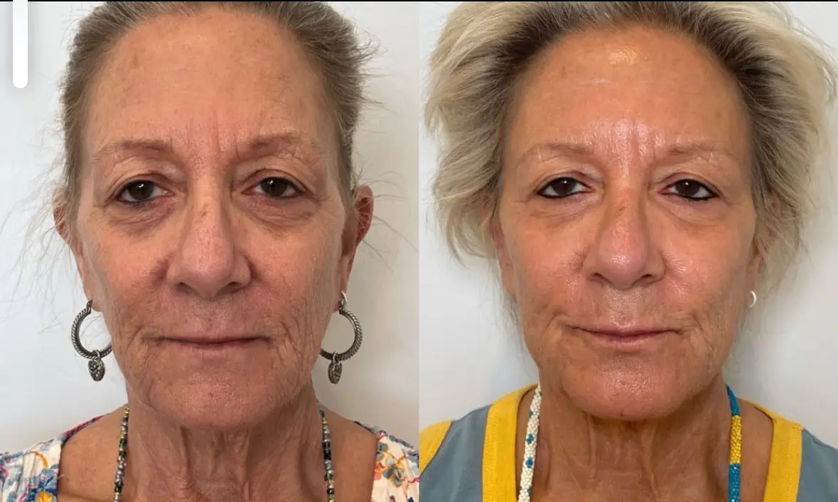 Sculptra treatment at Perfect Dose Med Spa in Scottsdale, Arizona