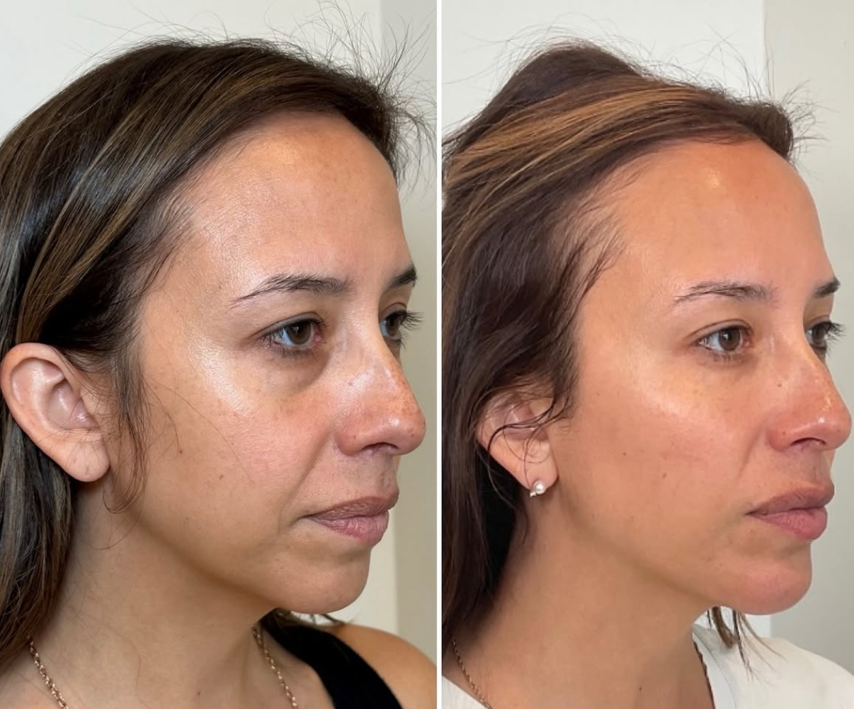 https://www.theperfectdose.com/wp-content/uploads/2025/07/full-facail-balancing-filler-sculptra.jpeg