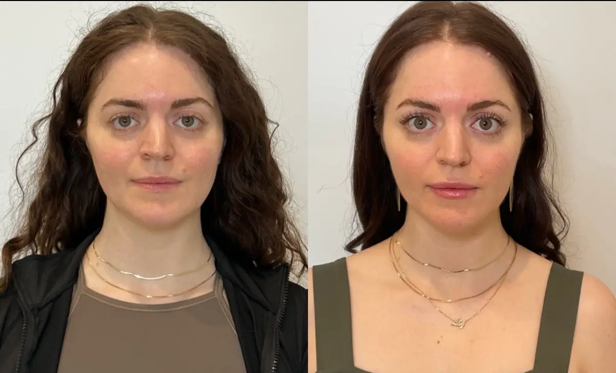 Sculptra treatment at Perfect Dose Med Spa in Scottsdale, Arizona